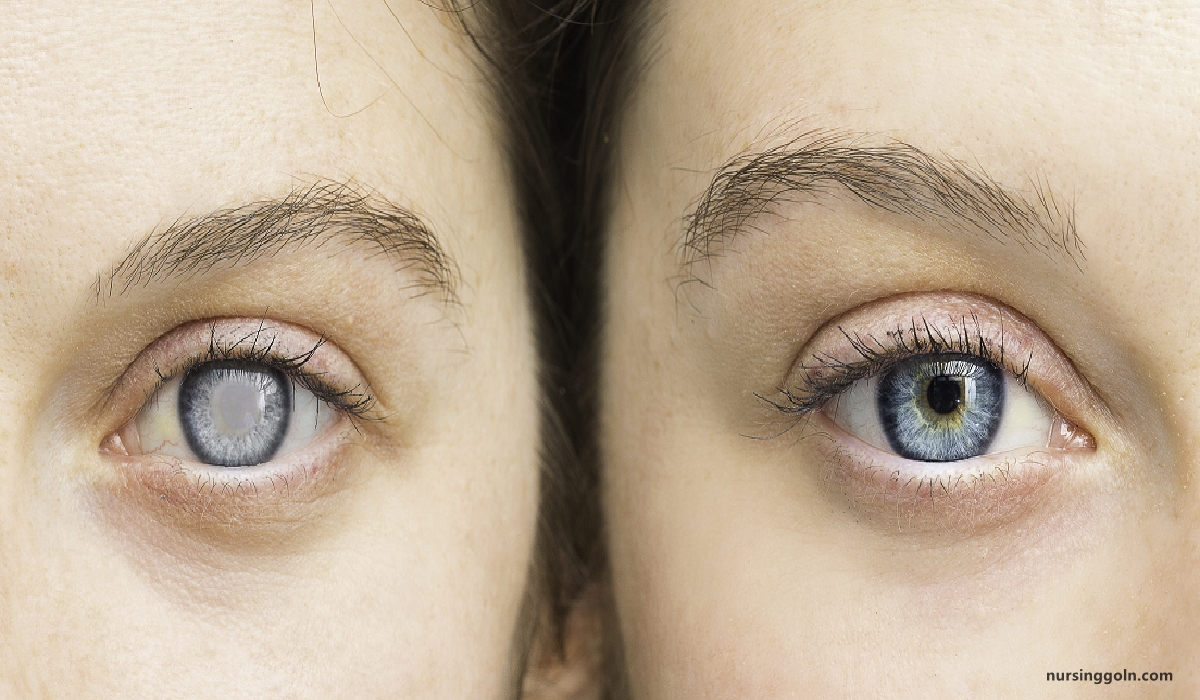 Definition of Glaucoma | CHAPTER-10 | Medical and Surgical Nursing