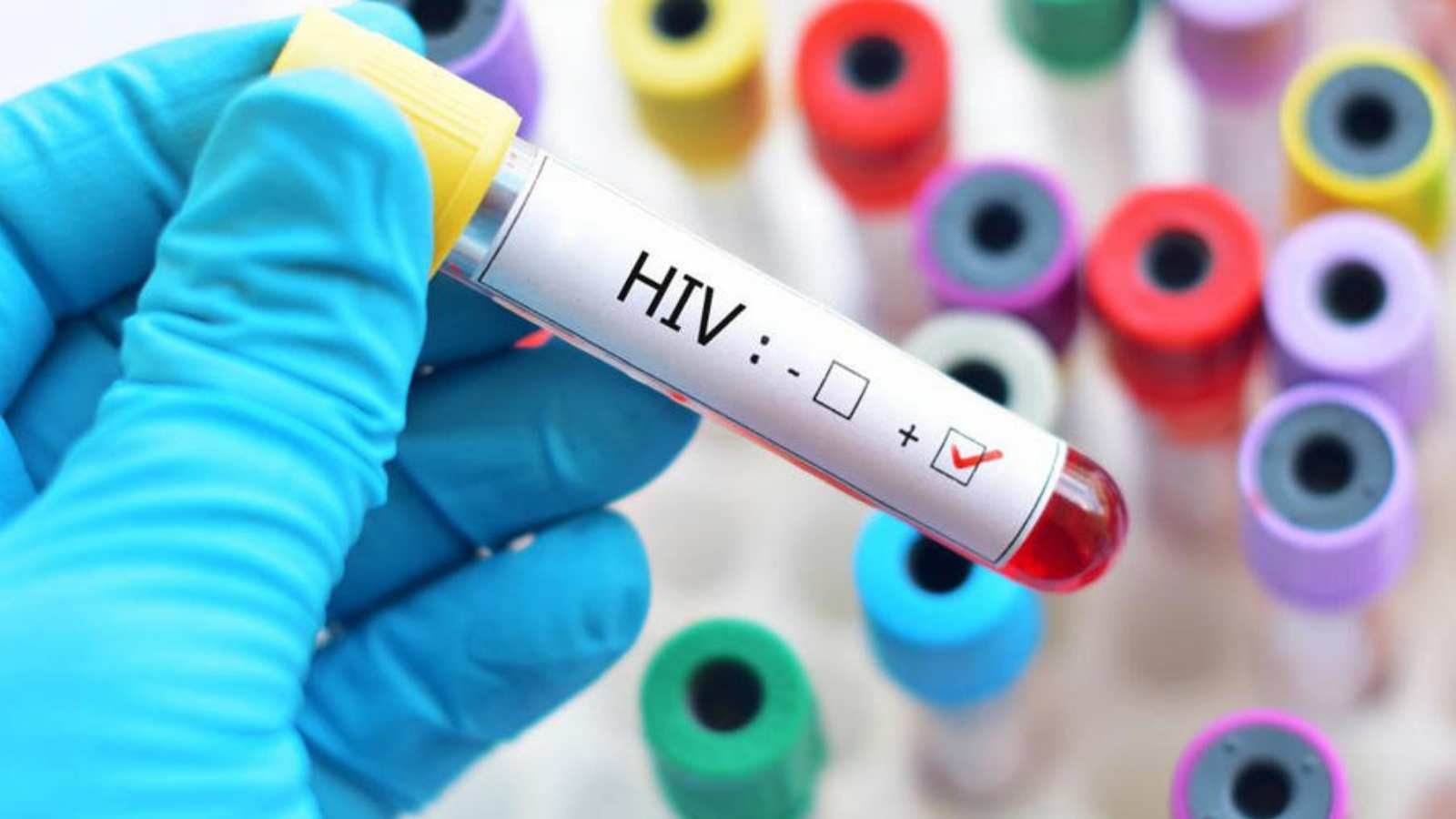 HIV or also AIDS | CHAPTER 7 | Nutrition and Dietetics