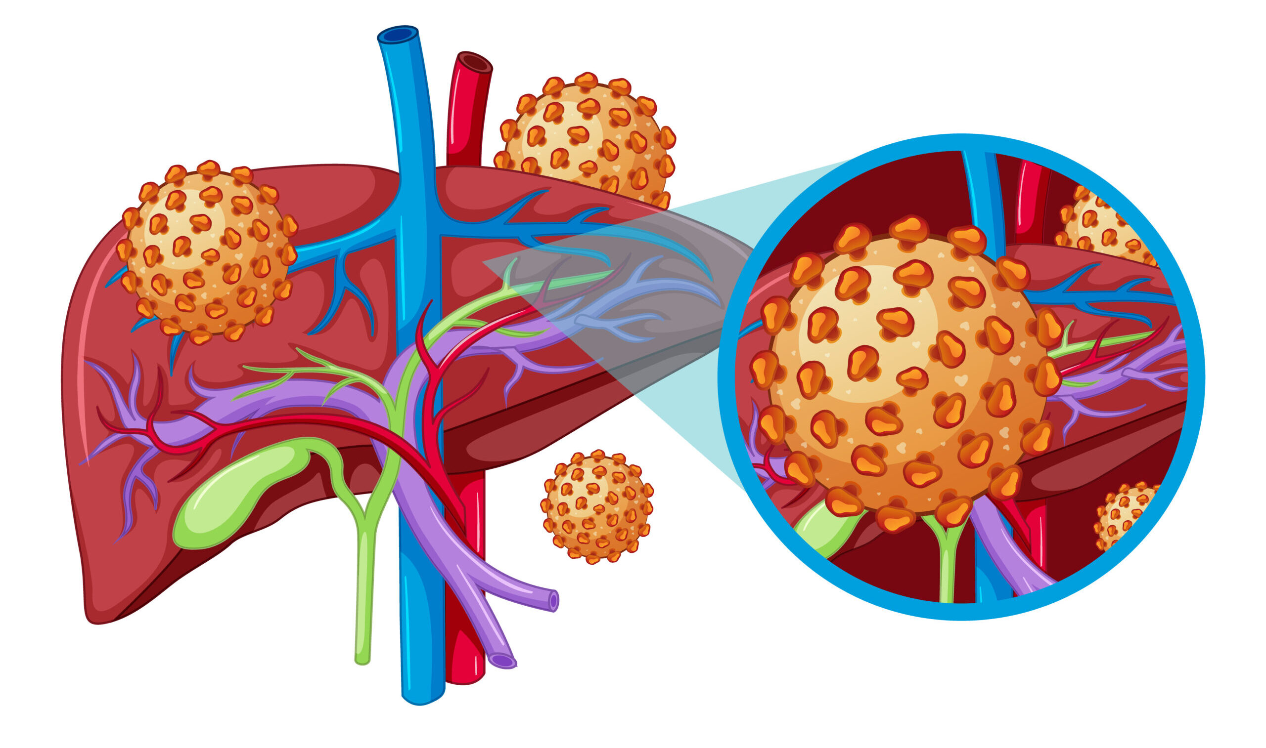 Concept about Hepatitis | CHAPTER 14 | Pediatric Nursing
