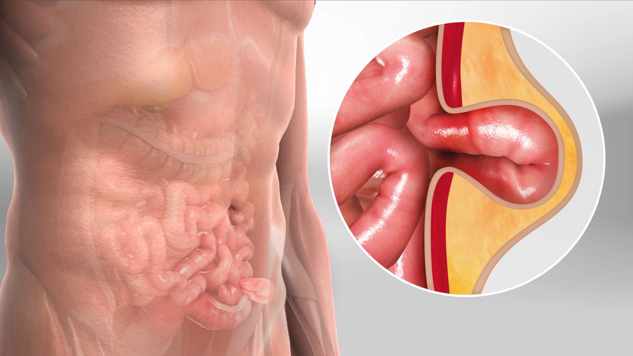 Definition of Hernia | CHAPTER-6 | Medical and Surgical Nursing
