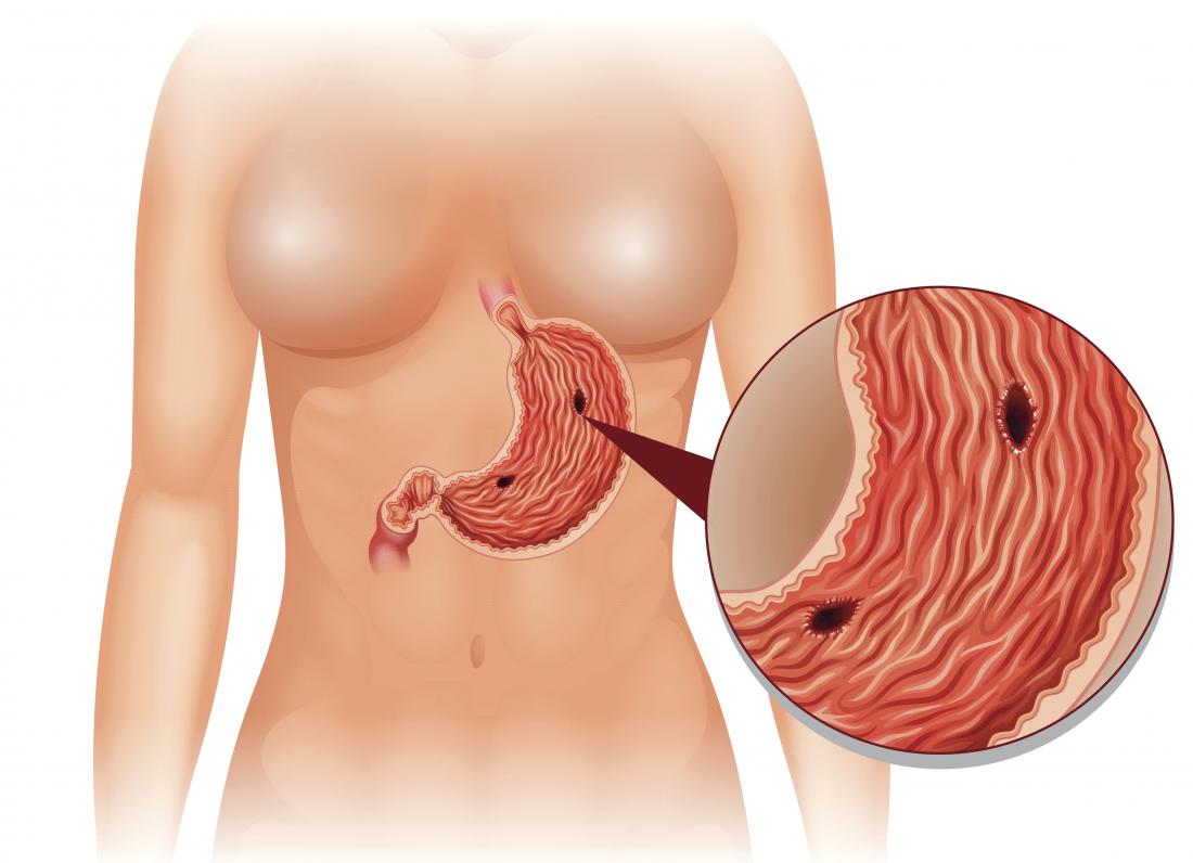 Intestinal perforation | CHAPTER-6 | Medical and Surgical Nursing
