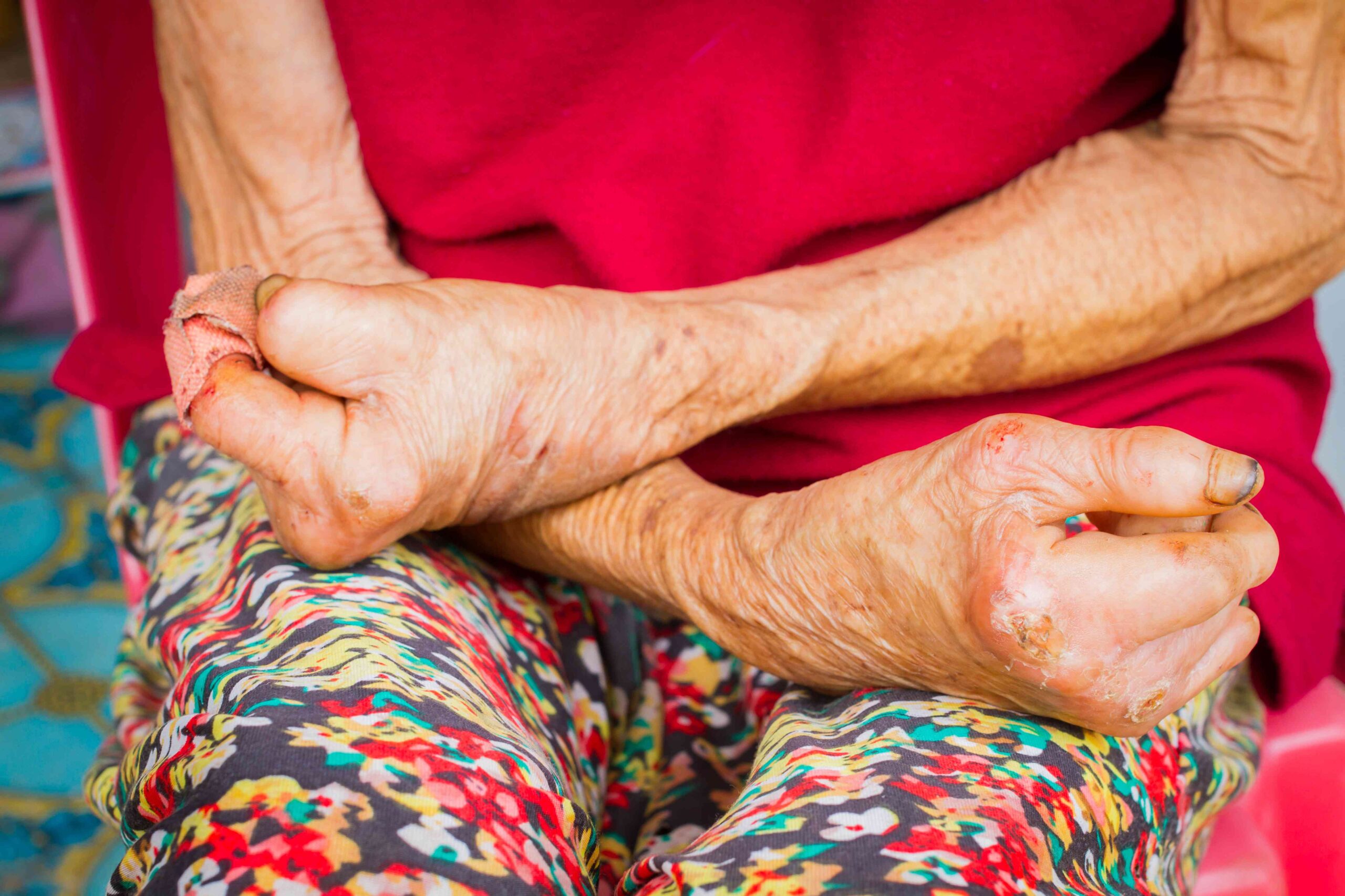 Definition of Leprosy | Chapter 5 | Medical And Surgical Nursing