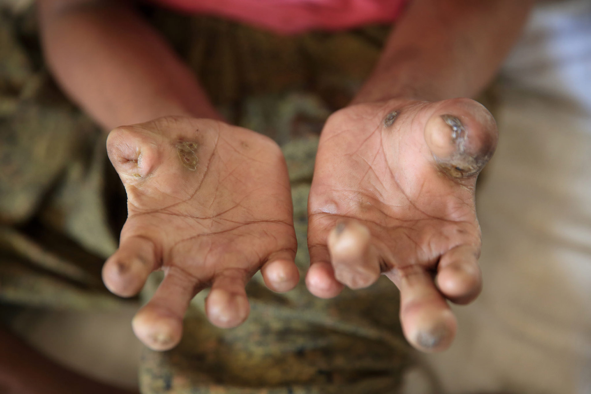Definition of Leprosy | Chapter 5 | Medical And Surgical Nursing