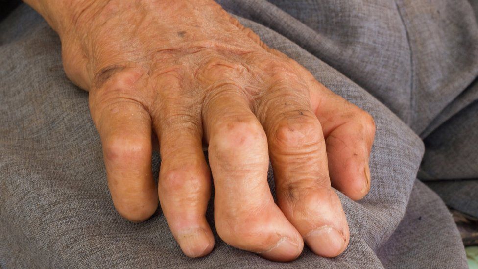 Definition of Leprosy | Chapter 5 | Medical And Surgical Nursing