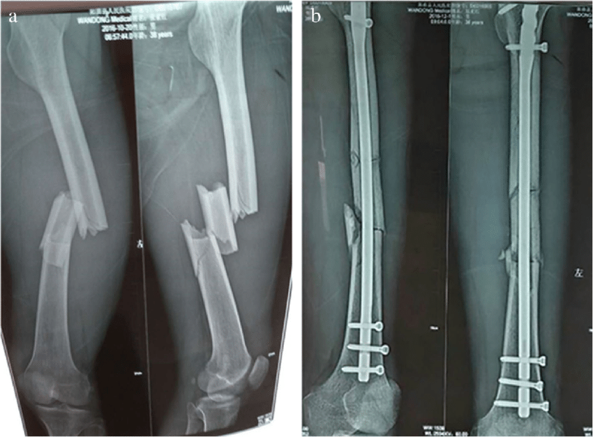 Lower limb fracture | CHAPTER 5 | Orthopedic Nursing