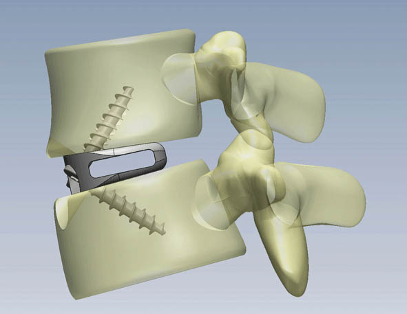 Definition of Arthrodesis | CHAPTER 10 | Orthopedic Nursing