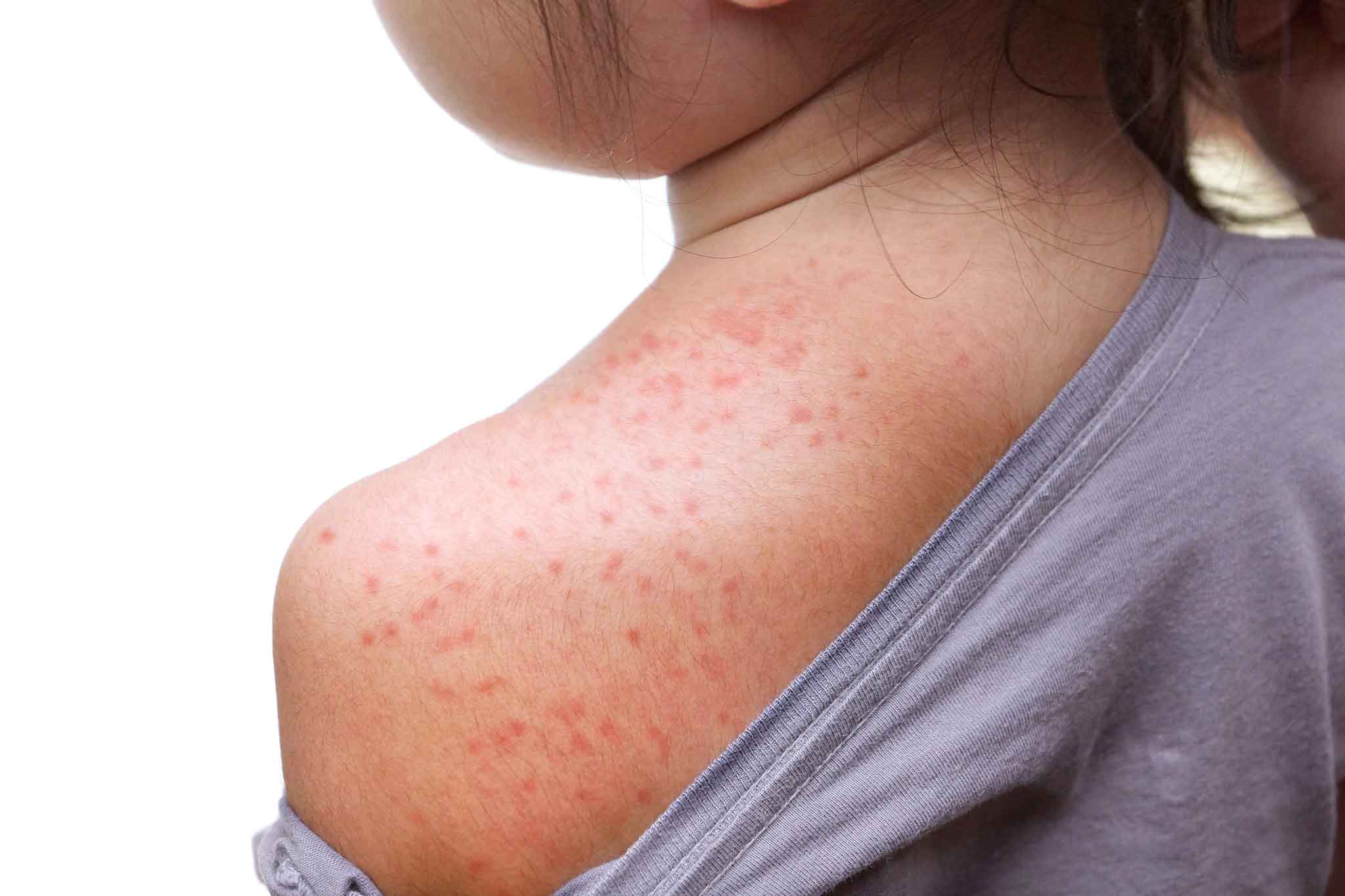 Definition of Measles | CHAPTER 6 | Pediatric Nursing