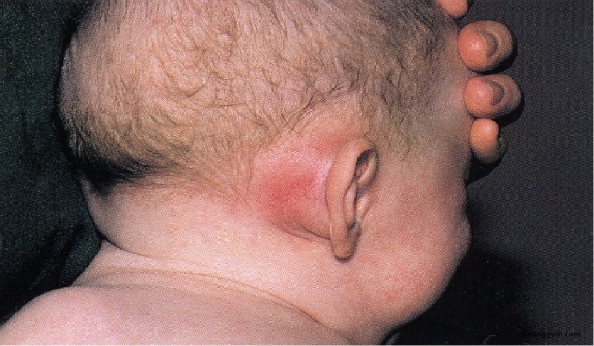 Definition of Mastoiditis | CHAPTER-10 | Medical and Surgical Nursing