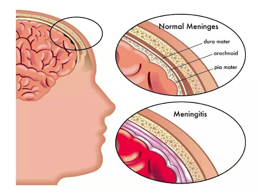 Concept of Meningitis | CHAPTER-14 | Medical and Surgical Nursing