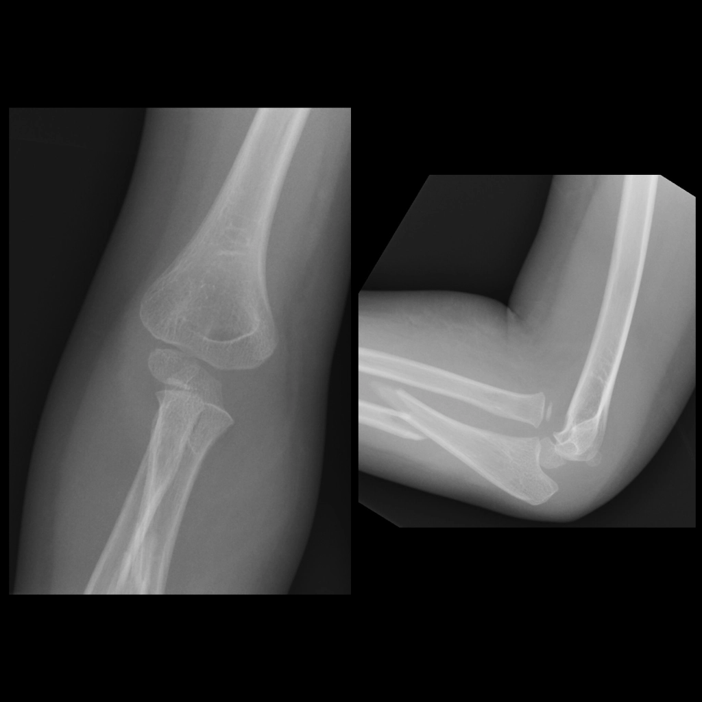 Monteggia fracture | CHAPTER 5 | Orthopedic Nursing