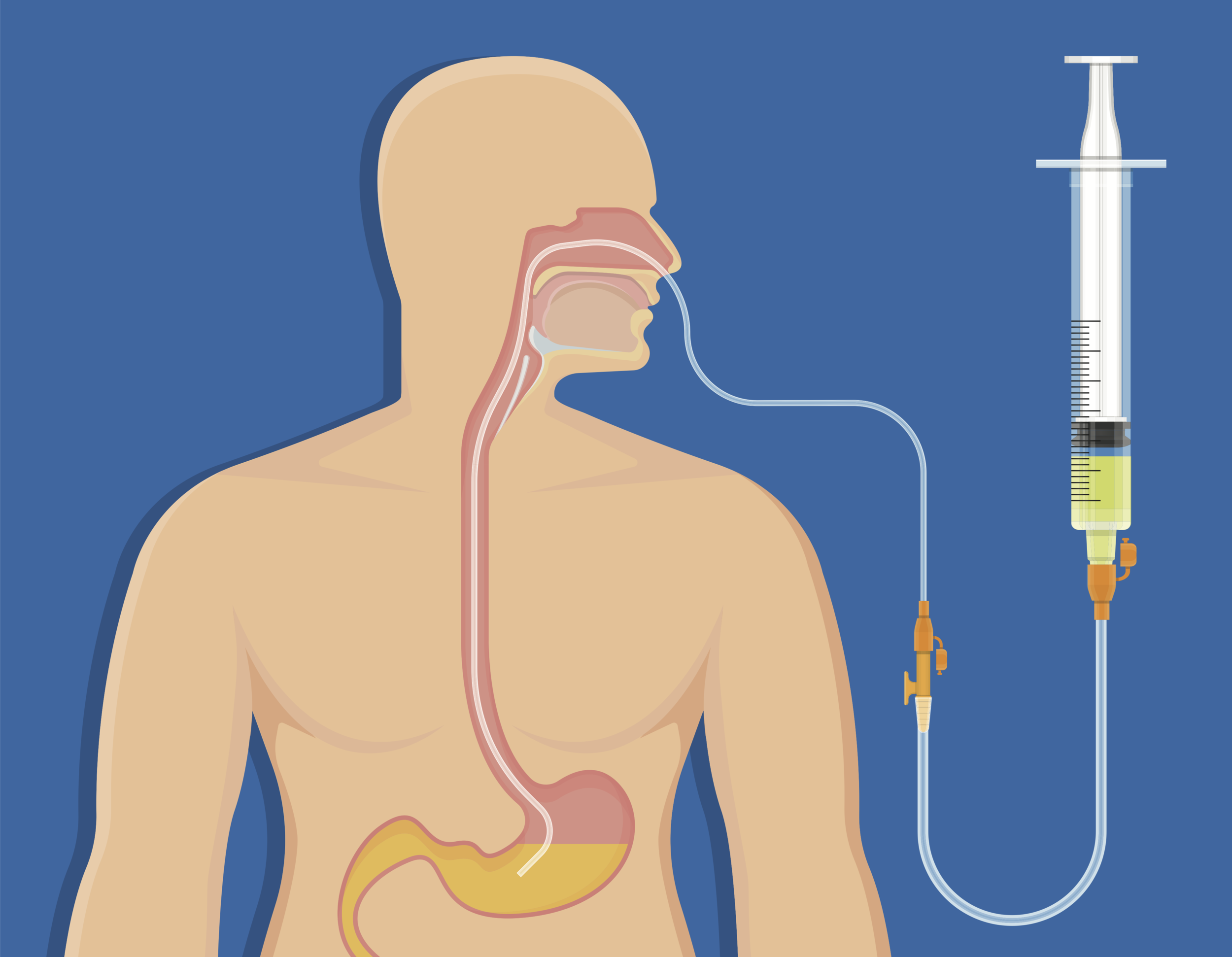 nasogastric tube feeding