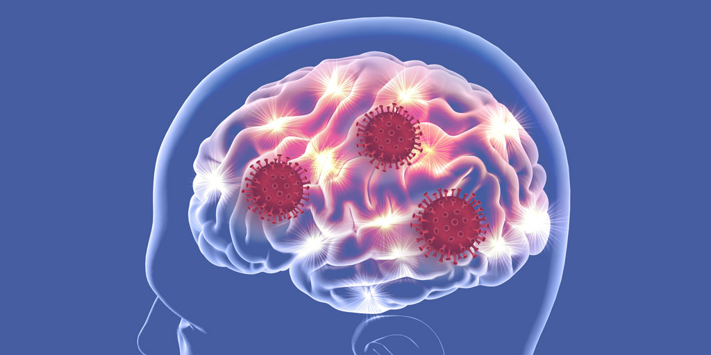 Viral Encephalitis
