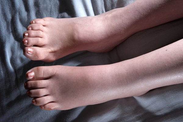 Definition of Oedema | CHAPTER-19: General Examination | Fundamentals of Nursing