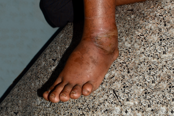 Definition of Oedema | CHAPTER-19: General Examination | Fundamentals of Nursing