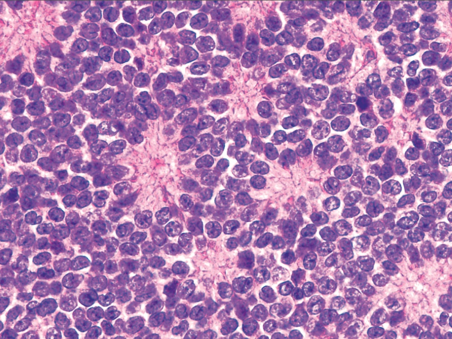 Concept about Ewing's sarcoma | CHAPTER 16 | Orthopedic Nursing