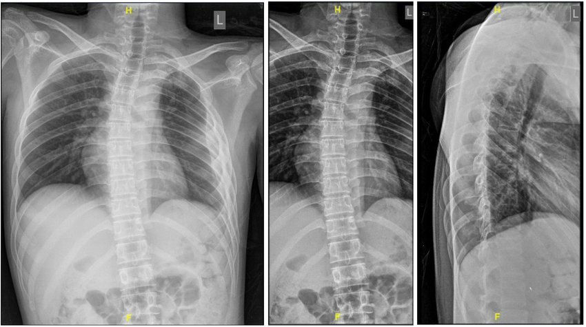 Concept about Ewing's sarcoma | CHAPTER 16 | Orthopedic Nursing