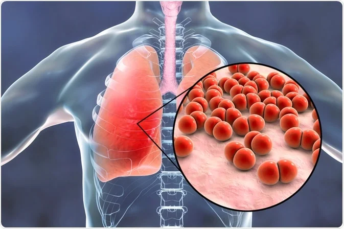 Medical Definition of Pneumonia | CHAPTER-8 | Medical and Surgical Nursing