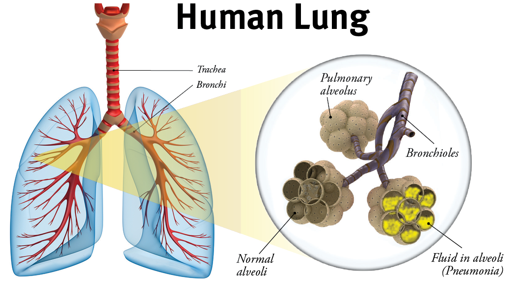 definition of pneumonia