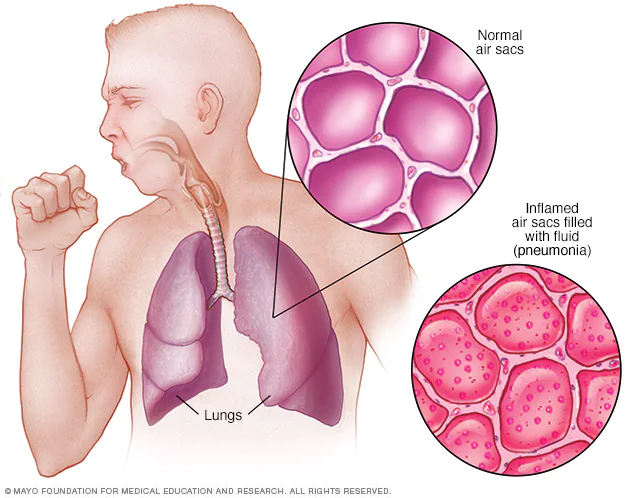 Pneumonia