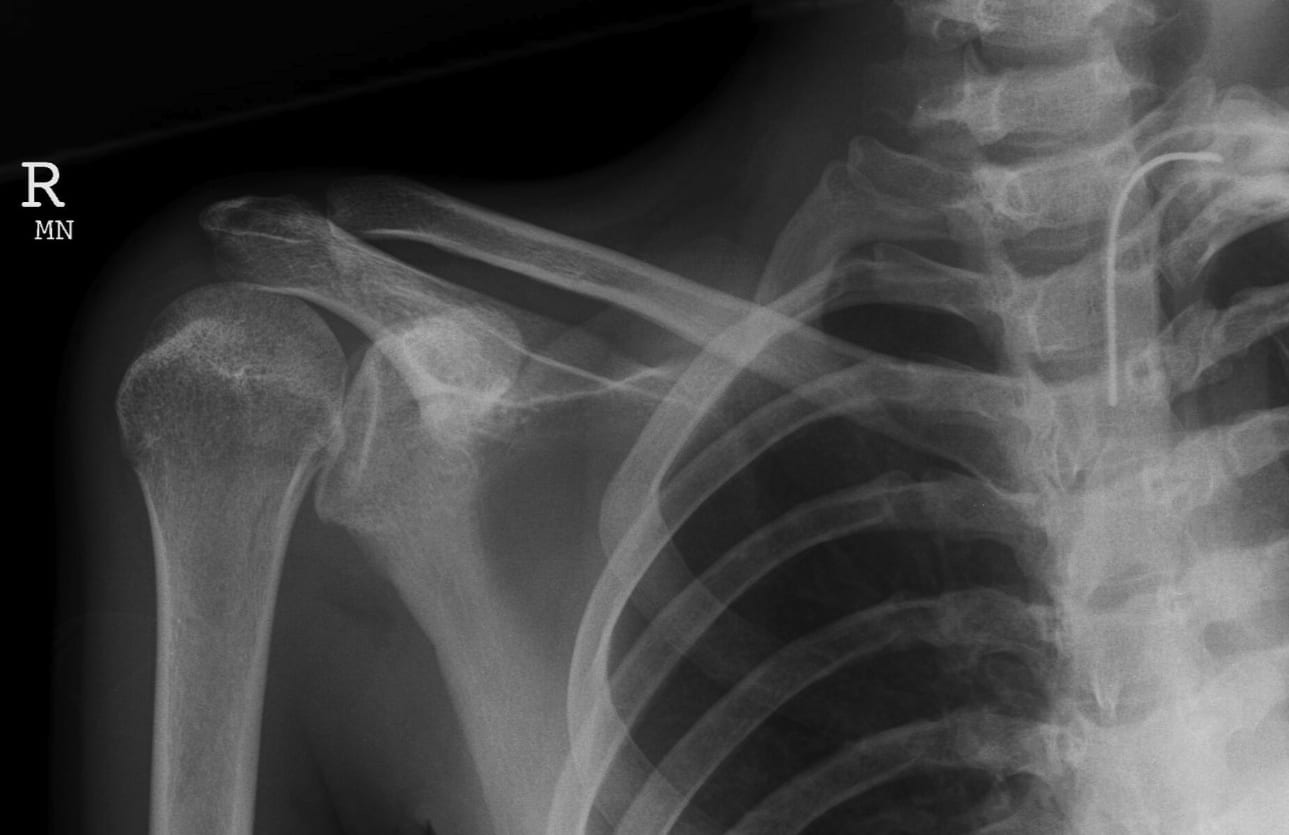 Posterior shoulder dislocation | CHAPTER 6 | Orthopedic Nursing