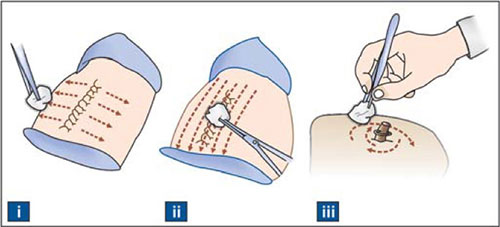 definition of wound