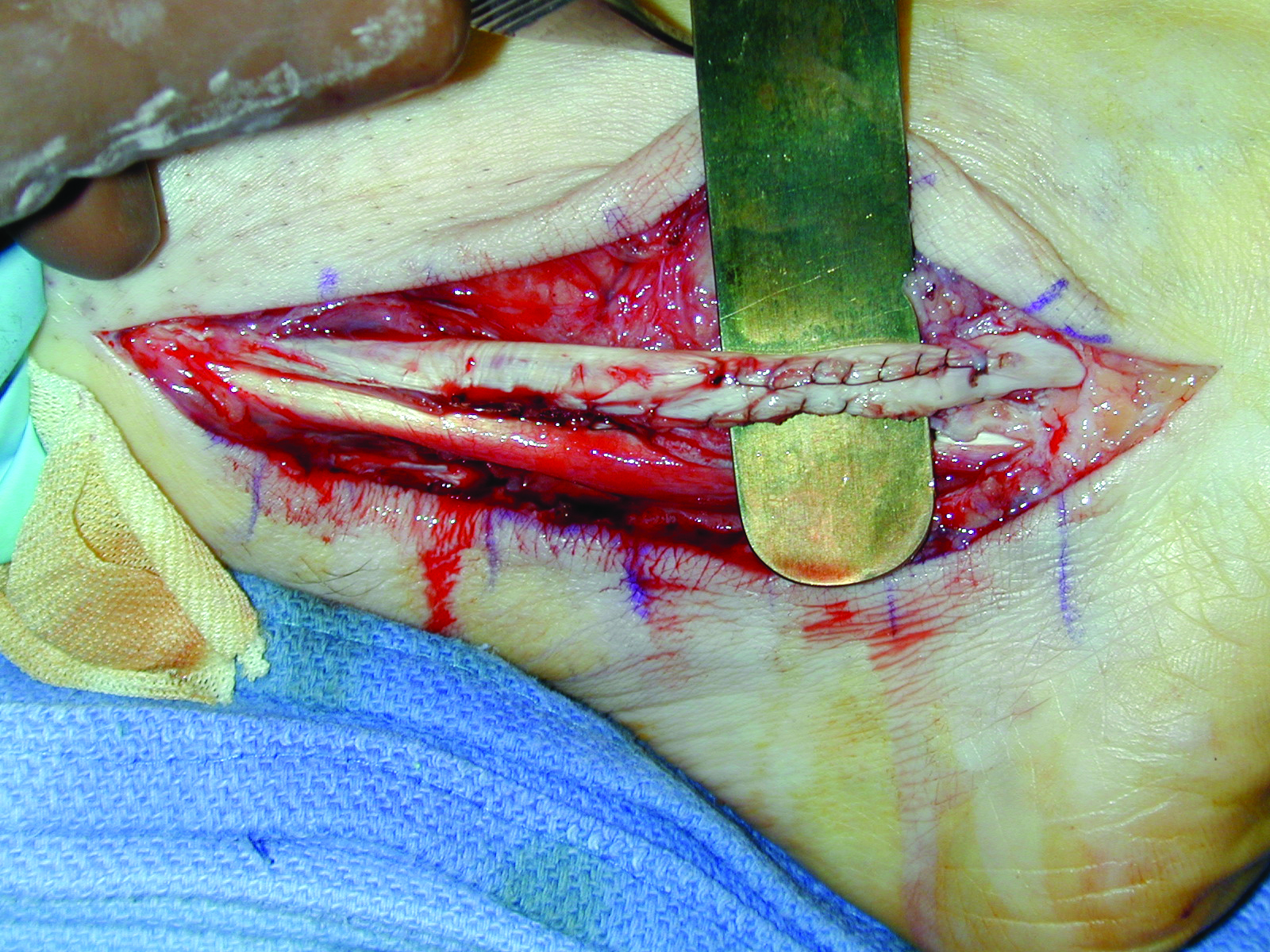 Tendon Repair | CHAPTER 11 | Orthopedic Nursing