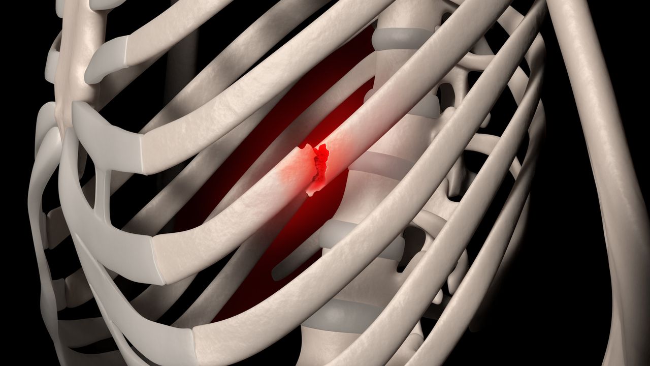 Rib fracture | CHAPTER 5 | Orthopedic Nursing