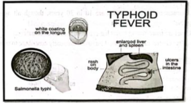 Medical Typhoid Fever | Chapter 5 | Medical And Surgical Nursing