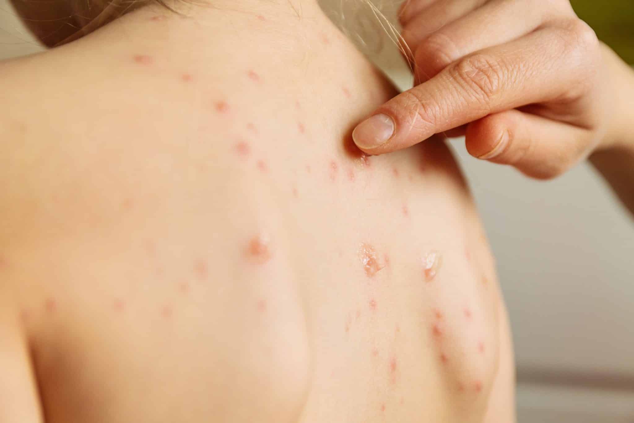 Definition of Skin Infection