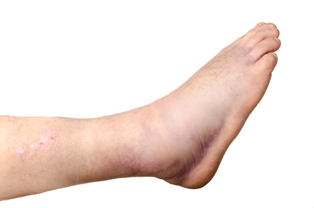 Soft tissue injury | CHAPTER 6 | Orthopedic Nursing