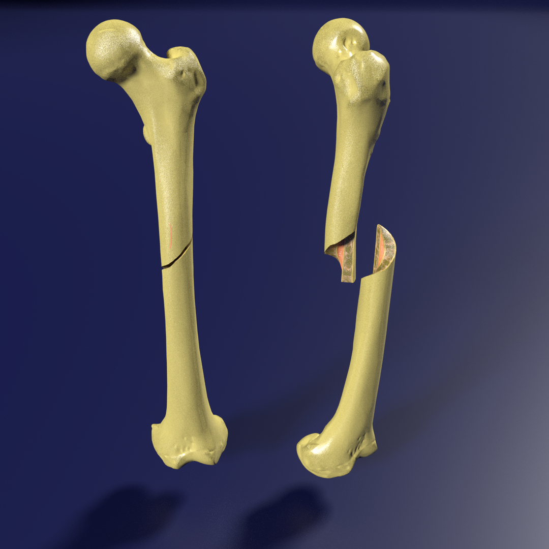 Medical Definition of Fracture