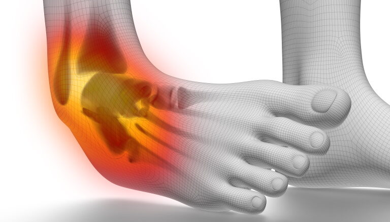 Medical Definition of Sprain | CHAPTER 6 | Orthopedic Nursing