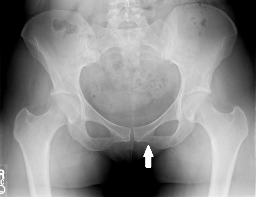 Pelvic fracture | CHAPTER 5 | Orthopedic Nursing