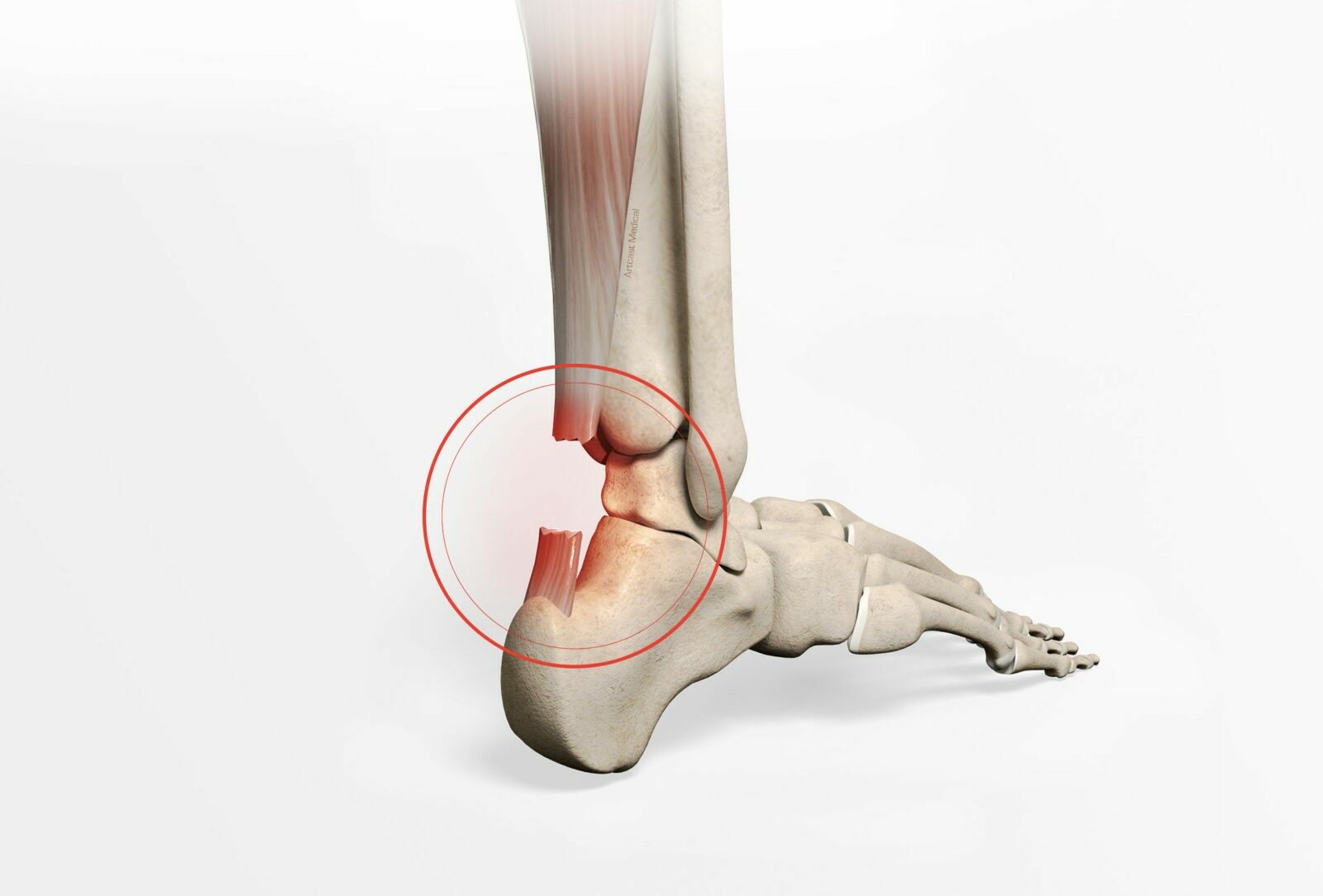 Tendon Repair | CHAPTER 11 | Orthopedic Nursing