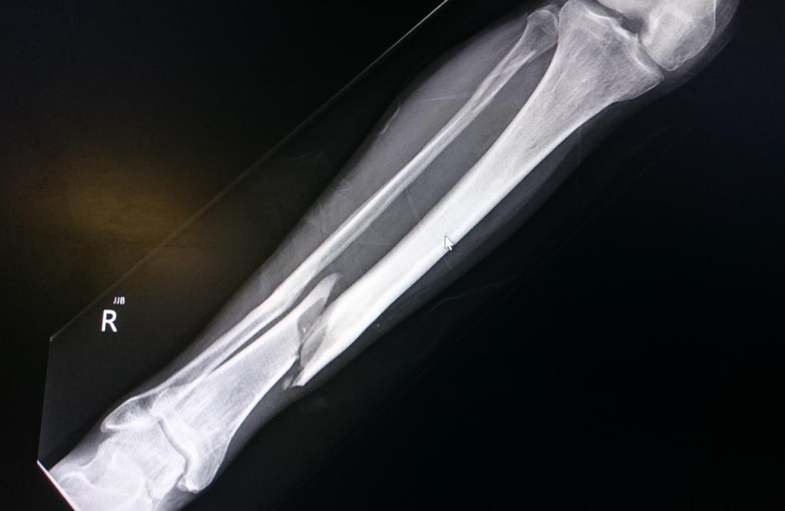 Tibial fracture | CHAPTER 5 | Orthopedic Nursing