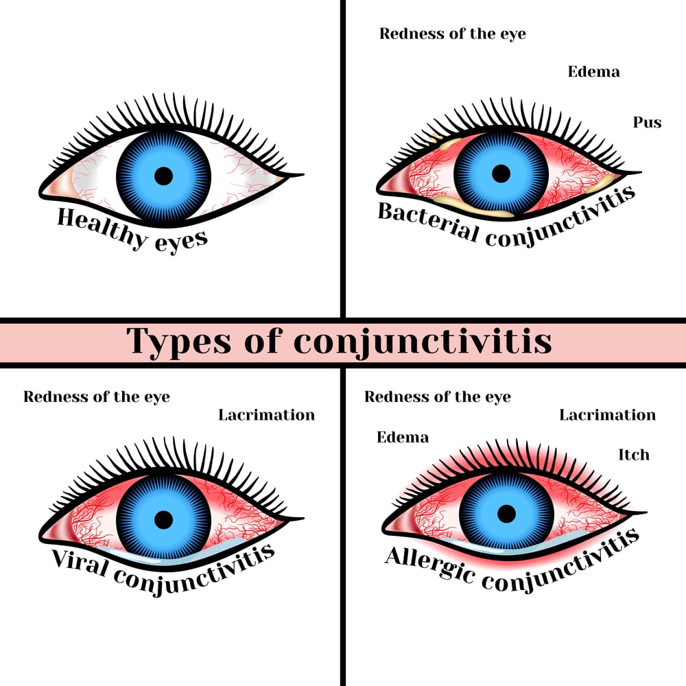 Types of conjunctivitis