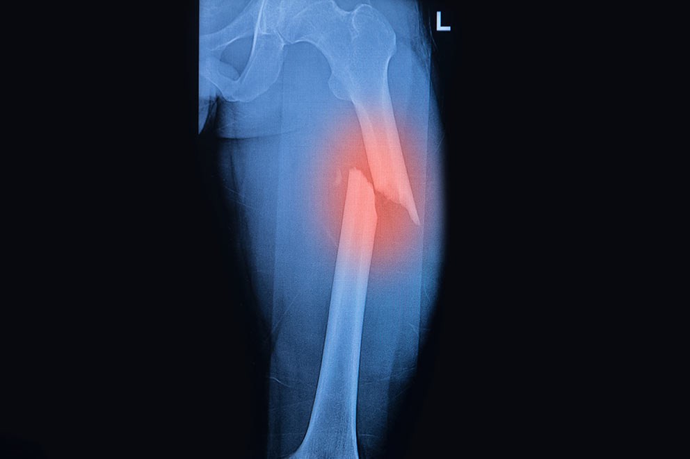 Closed Fracture | CHAPTER 5 | Orthopedic Nursing