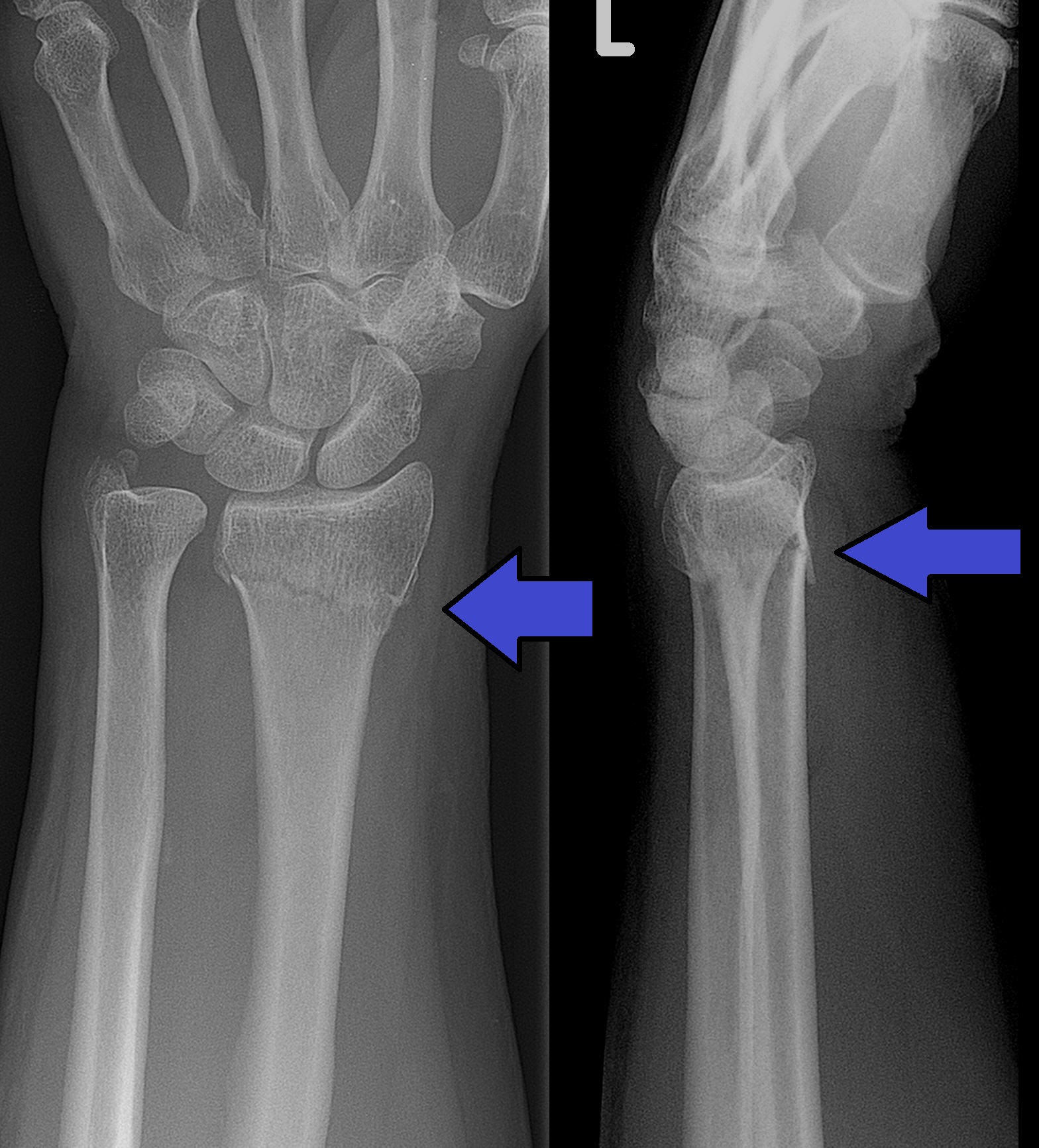 Closed Fracture | CHAPTER 5 | Orthopedic Nursing