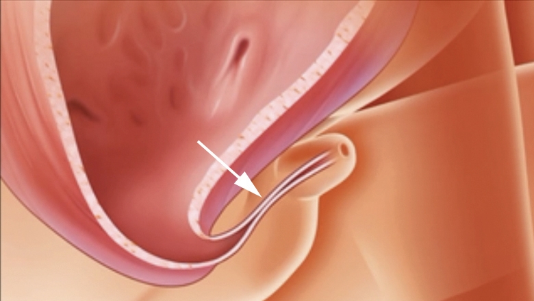 Urinary Tract Obstruction | Chapter 7 | Medical And Surgical Nursing