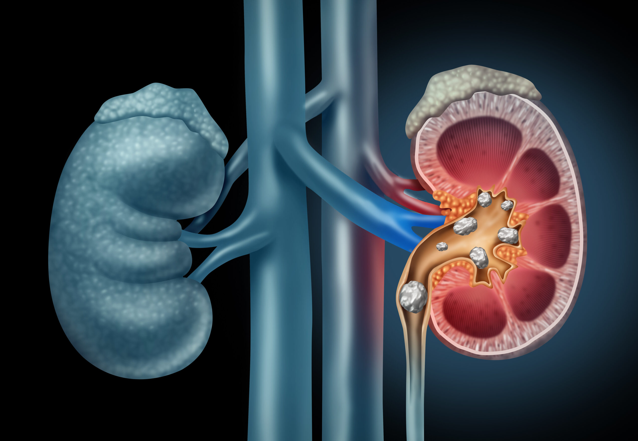 Definition of Urolithiasis | Chapter 7 | Medical And Surgical Nursing