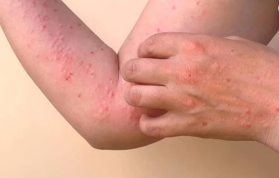 Definition of Chikungunya | Chapter 5 | Medical And Surgical Nursing