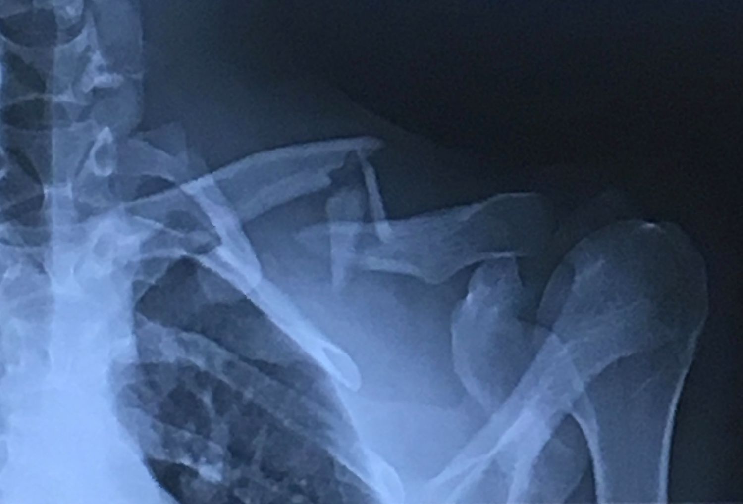 Fracture of clavicle | CHAPTER 5 | Orthopedic Nursing