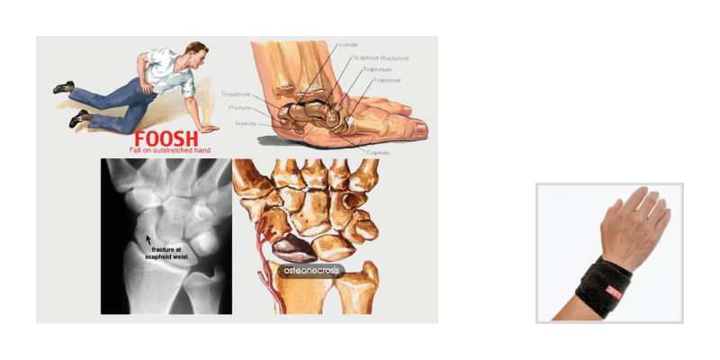 Medical Definition of Fracture