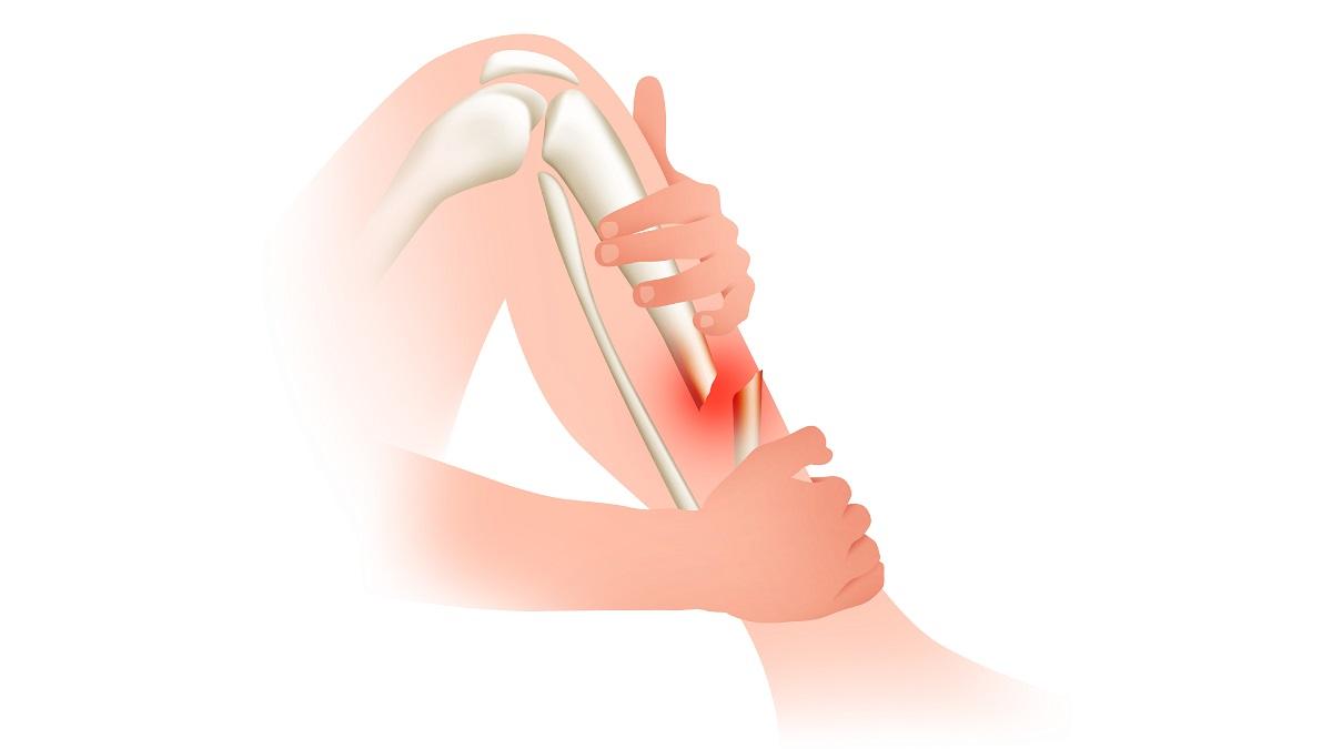 Open Fracture | CHAPTER 5 | Orthopedic Nursing