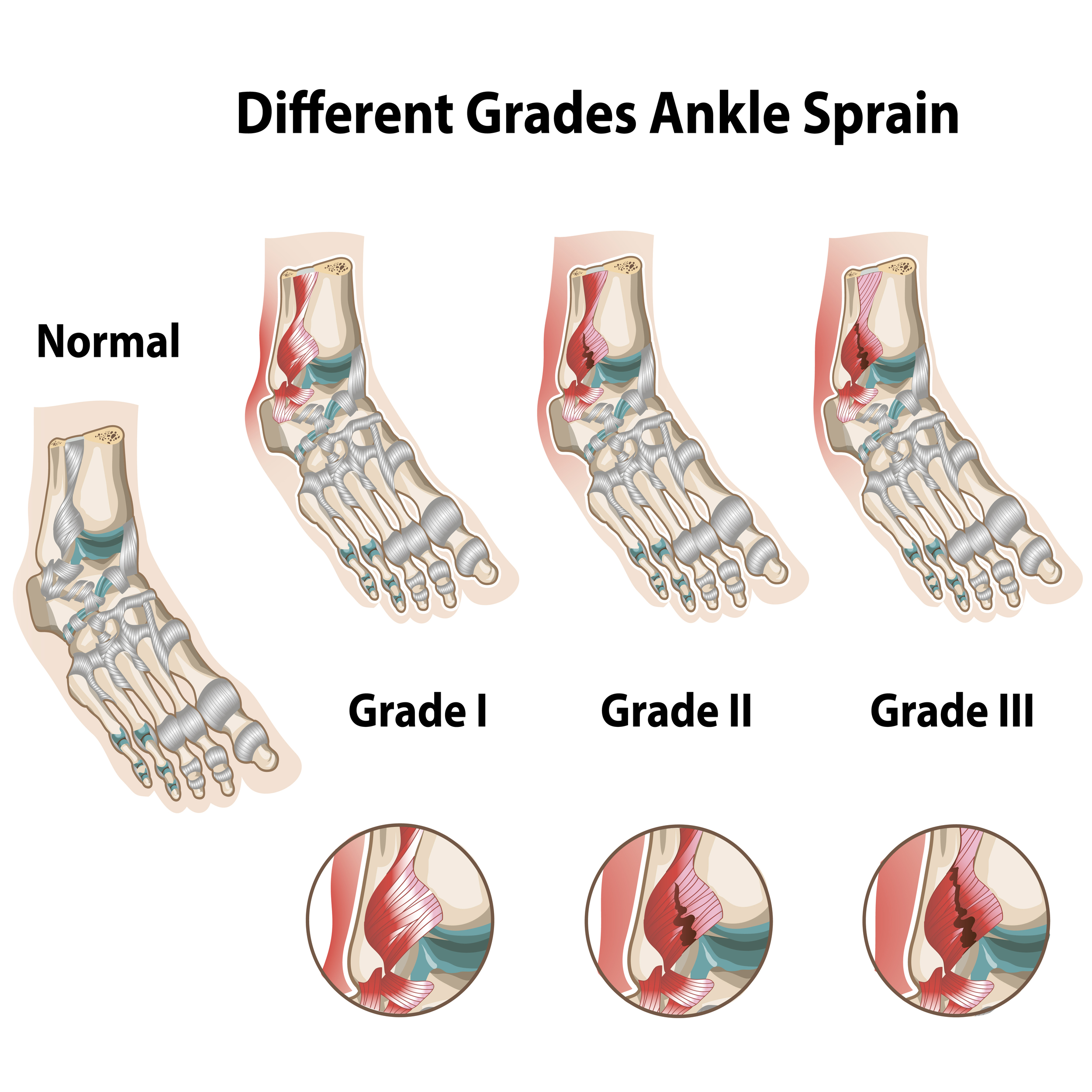 Definition of Sprain | CHAPTER 21 | Fundamentals of Nursing