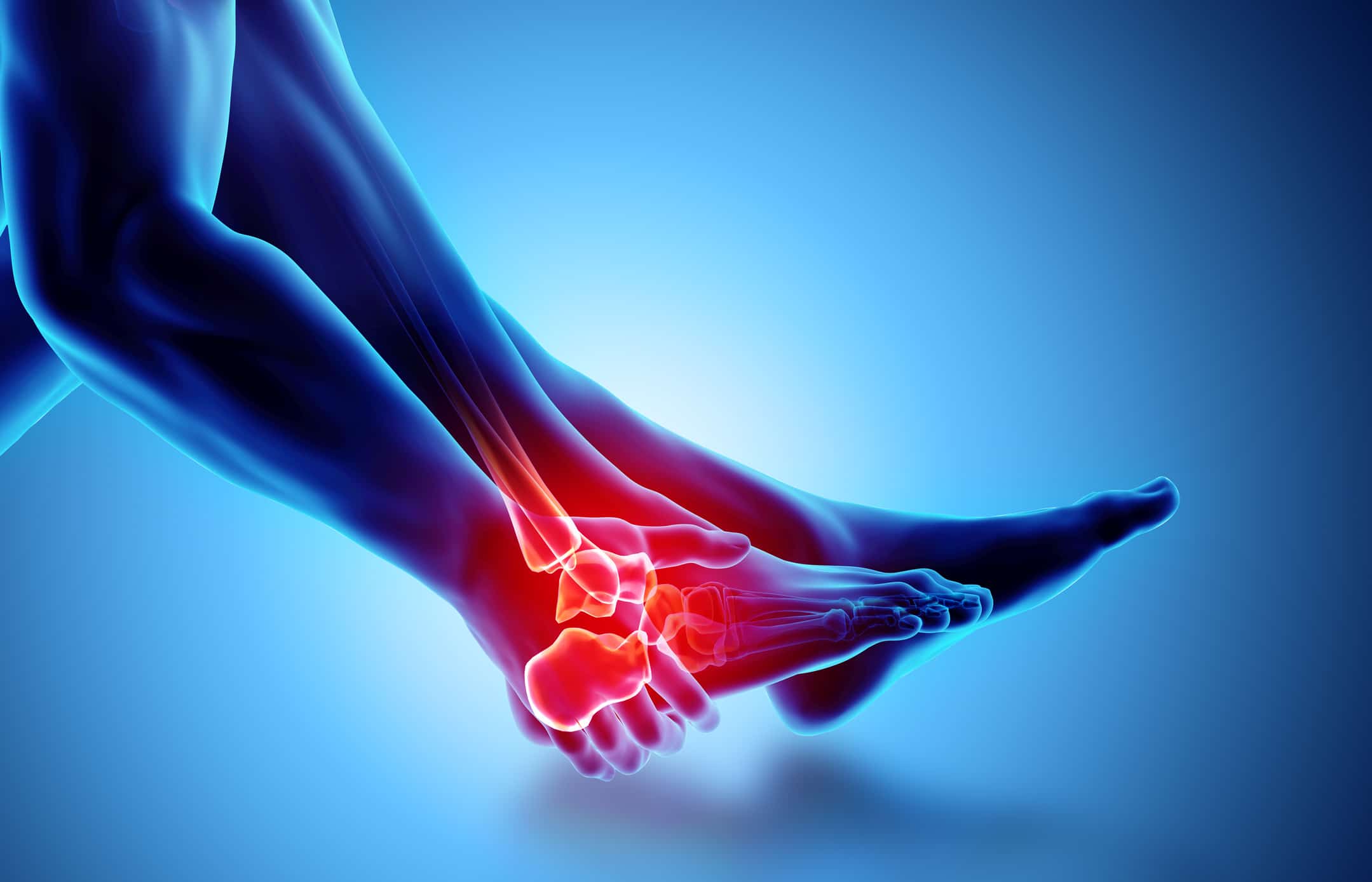 Definition of Sprain | CHAPTER 21 | Fundamentals of Nursing