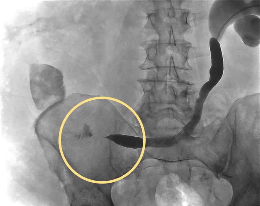 Urinary Tract Obstruction | Chapter 7 | Medical And Surgical Nursing