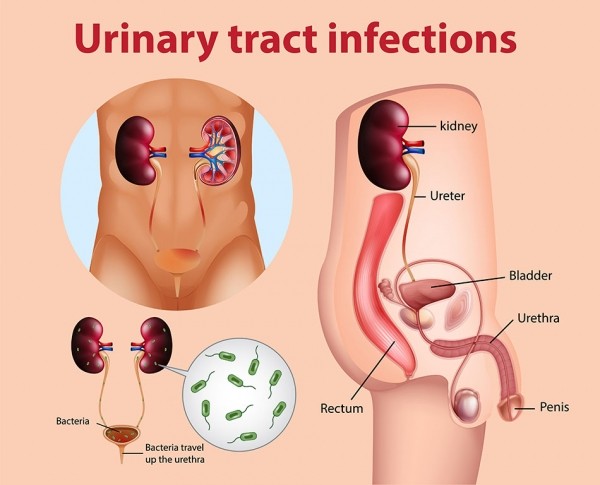 Definition of Urinary Tract Infection (UTI) | Chapter 12 | Midwifery For Diploma In Nursing