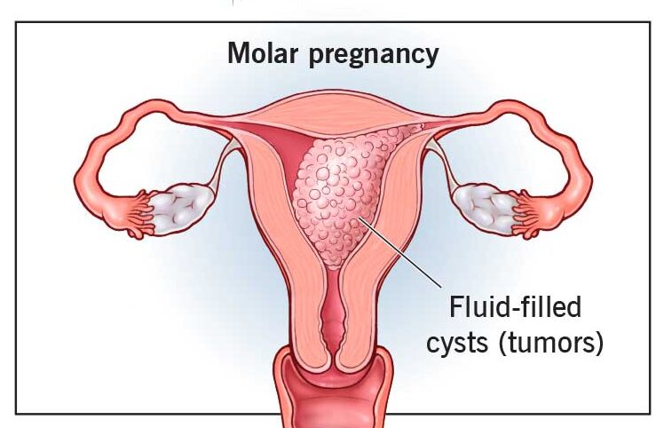Hydatidiform Mole | Chapter 17 | Midwifery For Diploma In Nursing