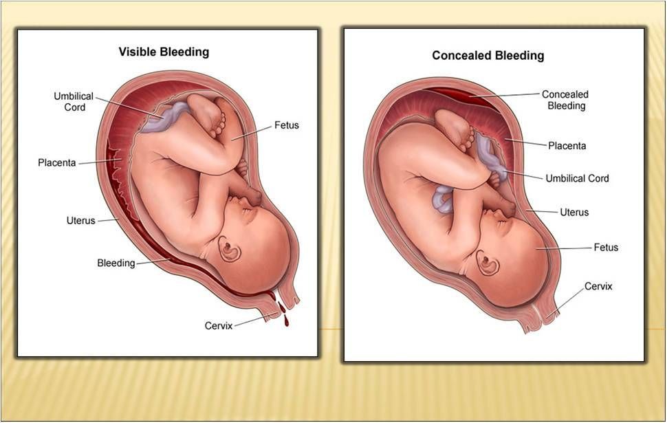 Ante Partum Haemorrhage | Chapter 11 | Midwifery For Diploma In Nursing